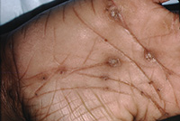 Punctate palmoplantar keratoderma